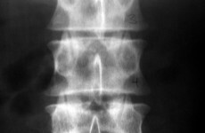 Acid-suppressing drugs linked to increased risk of fracture