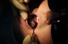 Screening uncovered 12 cases of mouth cancer last year