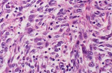 Minister will approve skin cancer 'wonder drug' when reimbursement deal is agreed