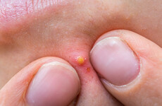 Poll: Where do you stand on pimple-popping as a pastime?