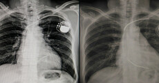 Medtech firms have a year to prepare for new EU rules but the inspectors aren't ready