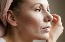 Rosacea: The do's and dont's of caring for the common skin condition