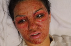 Love Island's Alexandra shared the aftermath of her CO2 peel, and it was harrowing