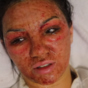 Love Island's Alexandra shared the aftermath of her CO2 peel, and it was harrowing