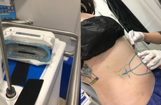 So, here's what happened when I got my fat frozen off AKA CoolSculpting