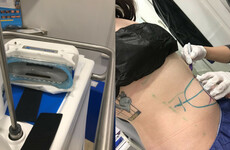 So, here's what happened when I got my fat frozen off AKA CoolSculpting