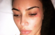 Suffering with psoriasis: What to know about the skin condition Kim Kardashian lives with