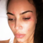 Suffering with psoriasis: What to know about the skin condition Kim Kardashian lives with