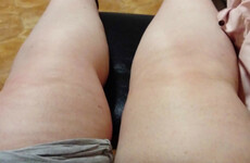Opinion: For years the doctors told me I was overweight but it turned out I had lymphoedema