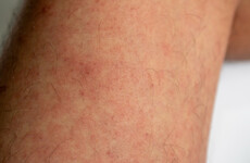Outbreak of measles in Dublin affecting young workers in city centre