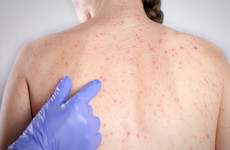 Irish measles cases rise over 200% as experts blame increase on misinformation about MMR vaccine