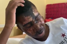 Waterford teenager says he 'can’t describe' pain of chemical attack but adds his sight is returning