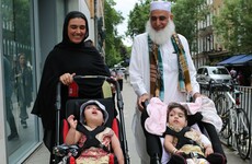 Conjoined twin girls separated in London after 55 hours of surgery