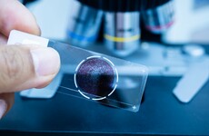 New test could make it easier to predict women's risk of developing cervical cancer