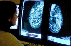 Irish cancer survival rates jump among wealthy nations - but ovarian cancer remains a concern