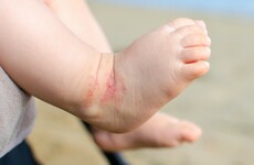 Could your child have a skin condition like eczema? 5 signs to watch out for, according to an expert