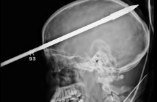 Florida teen recovering after being shot through head with spear