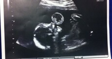 Unborn baby has tumour removed through groundbreaking in utero surgery