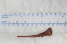 Doctors discover Dublin woman (81) suffering stomach pains had swallowed chicken bone