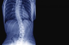 Parents of children affected by scoliosis spinal rod recall to be contacted by surgeons in next 24 hours