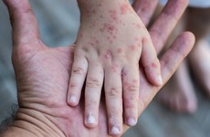 First case of rubella in Ireland in more than a decade confirmed at company in Cork