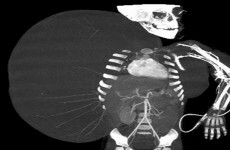 Doctors remove 33-pound tumour from child, 2, who weighs 26-pounds