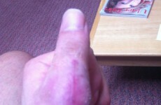 Thumbs up! Stephen Ferris will be back playing rugby soon