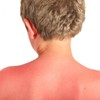 Warning to protect children in the sun as 90% of 10-17 year olds say they've had sunburn at least once