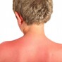 Warning to protect children in the sun as 90% of 10-17 year olds say they've had sunburn at least once