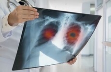 2,000 cancer diagnoses may not have been made due to impact of Covid-19 on services