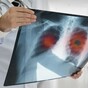 2,000 cancer diagnoses may not have been made due to impact of Covid-19 on services