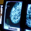 Existing drug could treat ‘aggressive’ triple-negative breast cancer – study
