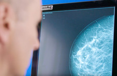 Artificial intelligence set to assist breast screening in Ireland