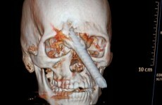 Brazilian worker survives bar through skull