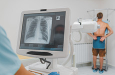 Opinion: Lung cancer screening must be introduced to address health inequalities