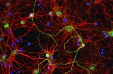 Lack of practical arrangements increase stress for Alzheimer's carers - survey