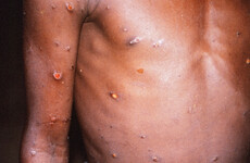 What is monkeypox and why are cases spreading in the UK and Europe?