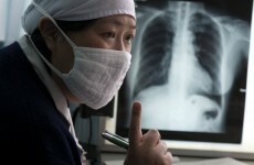 'Extensively drug-resistant' tuberculosis on the rise worldwide