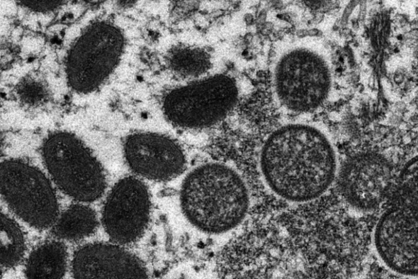 Second case of monkeypox confirmed in Ireland by HSE - Vimarsana News
