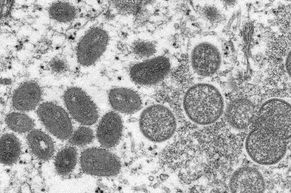 More than 700 monkeypox cases detected globally - CDC - Vimarsana News