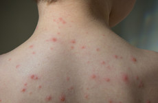 Chickenpox jab could be added to childhood immunisation schedule