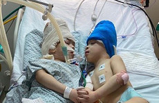 Conjoined twins with fused brains successfully separated in Brazil