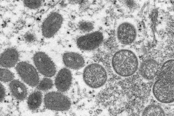 Number of monkeypox cases in Ireland rises to 97 - Vimarsana News