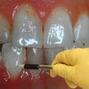 42 per cent of Irish adults "are missing teeth"