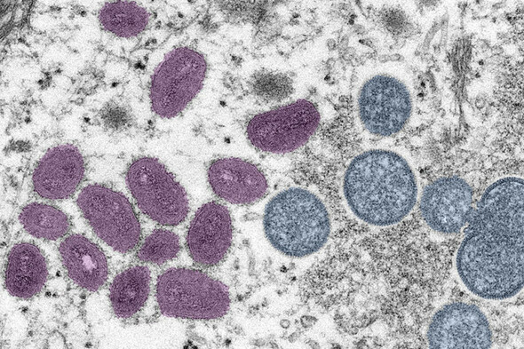 Strength of gay community response to monkeypox was 'key' in controlling outbreak - Vimarsana News