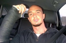 Bad break: Stephen Ireland pictured with arm in a cast