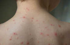Chickenpox vaccine for children moves a step closer as Hiqa says it's 'safe and cost effective'