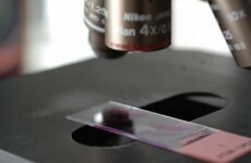 Older women not availing of important cervical cancer screenings - report