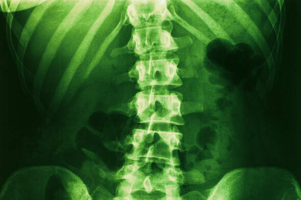 Donnelly: 'Children waiting for spinal surgeries have been failed by their own country' - Vimarsana News