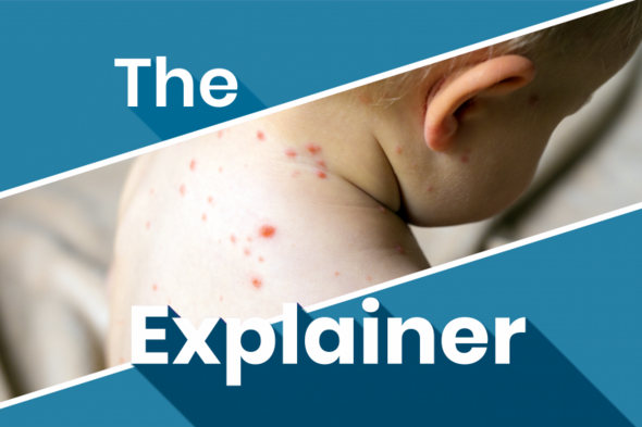 The Explainer: Why is measles on the rise again? - Vimarsana News